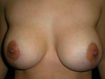 Breast Lift Case 1 After
